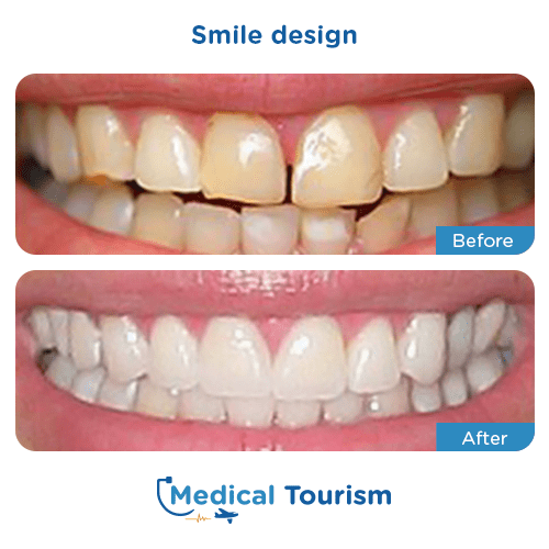 Patient before and after smile design