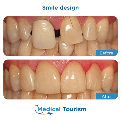 Patient before and after smile design