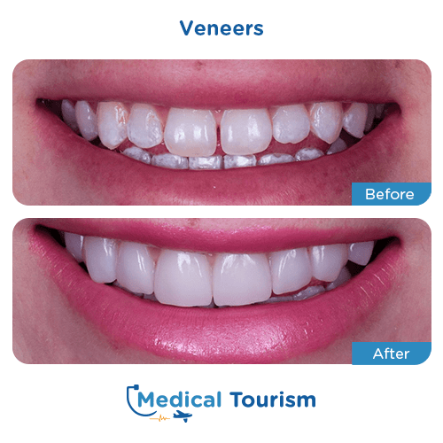 Dental veneers before and after medical tourism international
