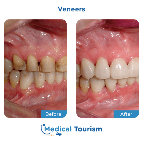Dental veneers before and after medical tourism international