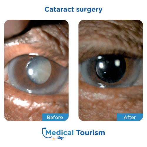 Aneurism before and after medical tourism international
