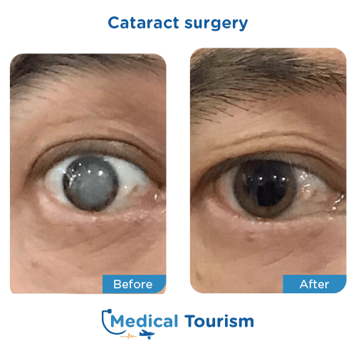 Aneurism before and after medical tourism international