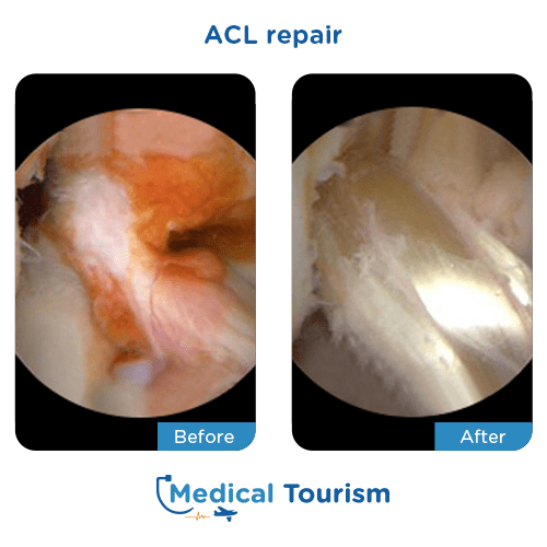 ACL repair before after