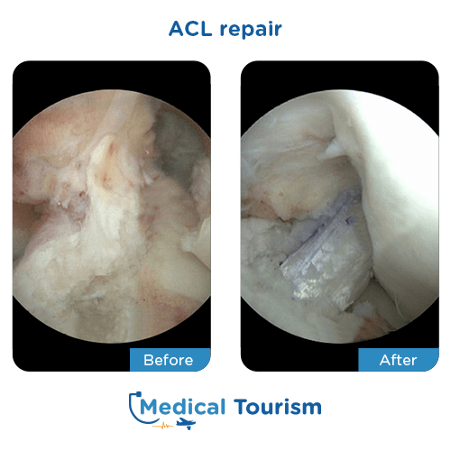 ACL repair before after