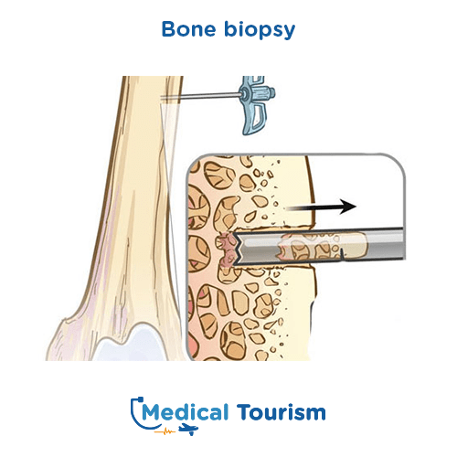 Bone biopsy before after