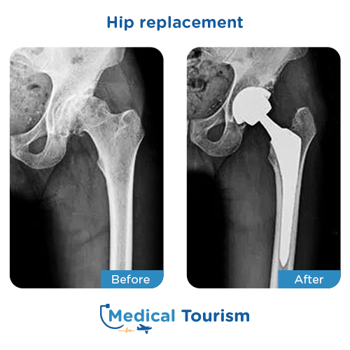 Hip replacement before after
