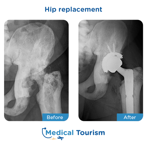 Hip replacement before after