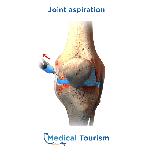 Joint aspiration before after