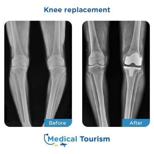 Knee replacement before after