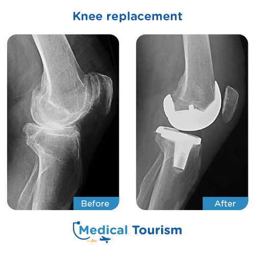 Knee replacement before after