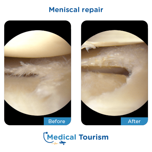 Meniscal repair before after