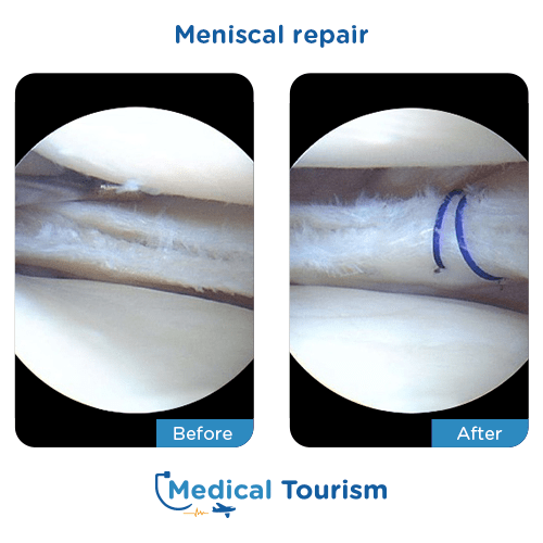 Meniscal repair before after