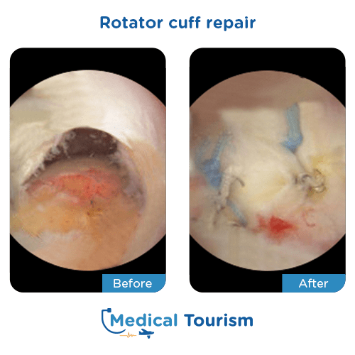 Rotator cuff repair before after