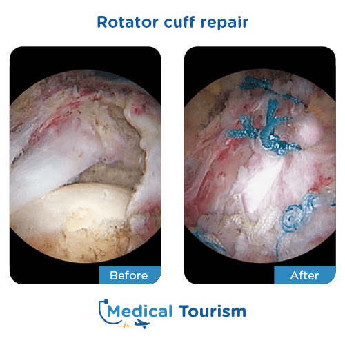 Rotator cuff repair before after