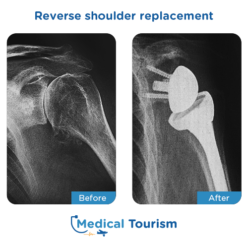 Shoulder replacement before after