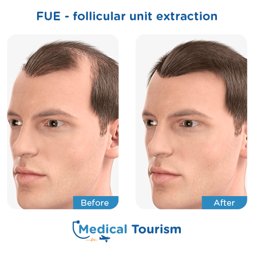 Illustrative image of FUE